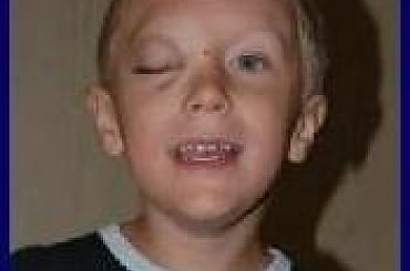 Michał Skoneczny - naczyniak malformacja naczyniowa --- http://pomagamy.dbv.pl #pomagamydbvpl #StronaInformacyjna #ApelOPomoc #LudzkaTragedia #PomocPotrzebującym #PomocDziecku #pomoc #PomocCharytatywna #rehabilitacja #turnusy #wolontariat #wsparcie