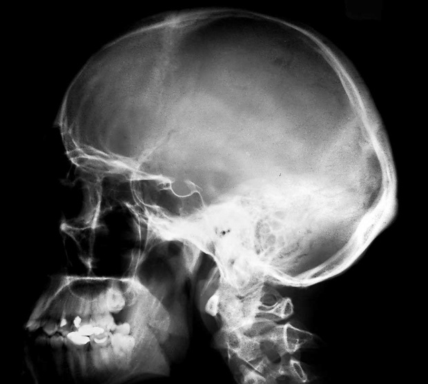 rentgen czaszki, czaszka ludzka #RentgenCzaszki #CzaszkaLudzka