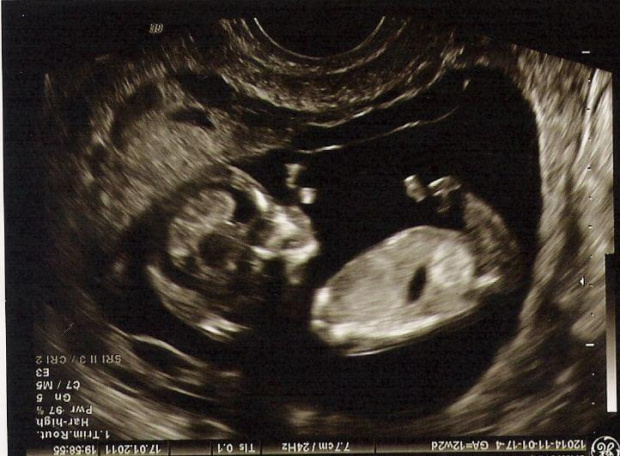 Mój dzidziuś w 12/13 tygodniu ciąży. Nabiera do buźki wodę i robi bąbelki :)